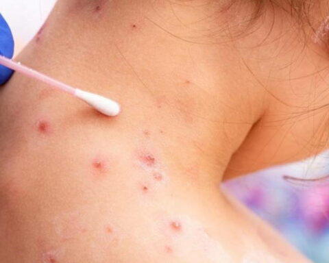 Viruela símica, MINSAP, Cuba