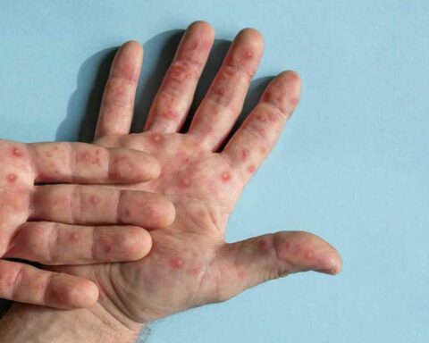 Monkeypox in Peru: infections rise to 2423