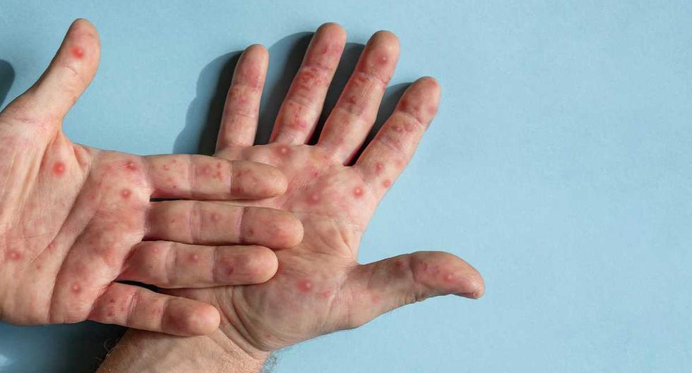 Monkeypox in Peru: infections rise to 2423