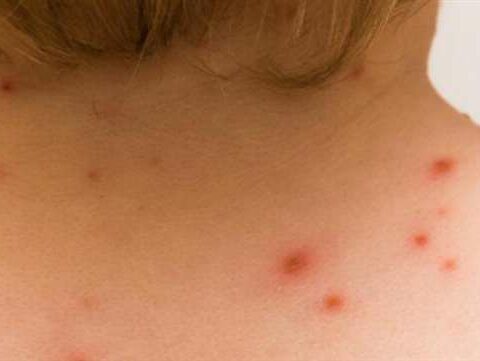 Santa Cruz continues to add cases of monkeypox