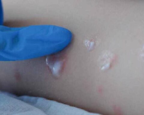 Six new cases of monkeypox in Santa Cruz bring active cases to 94