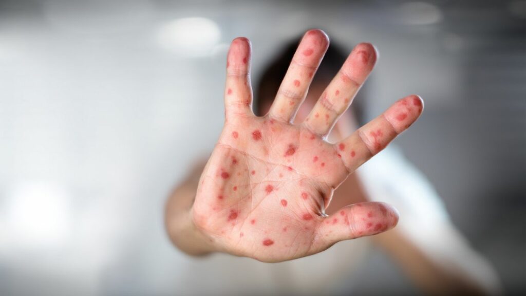 The Ministry of Health of the Nation confirmed 326 cases of monkeypox