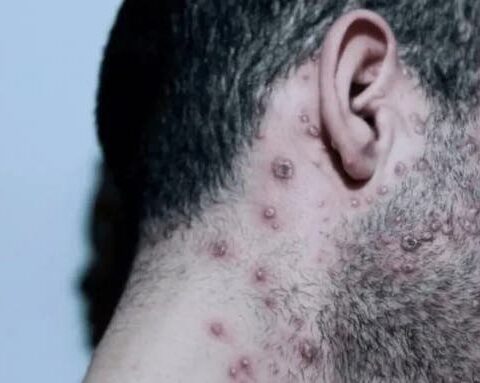 Suben a 27 los casos de viruela del mono; detectan dos nuevos