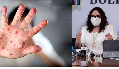 Monkeypox in Bolivia: 86 active cases and 142 people recovered