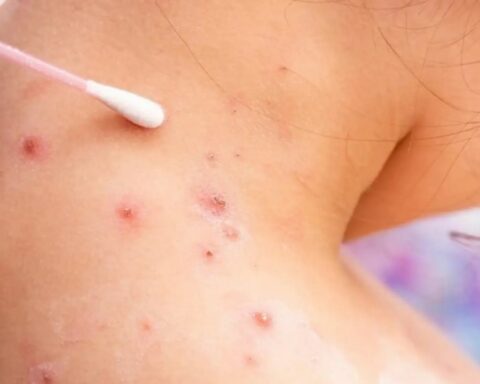 Monkeypox: the first case in children in the country is confirmed