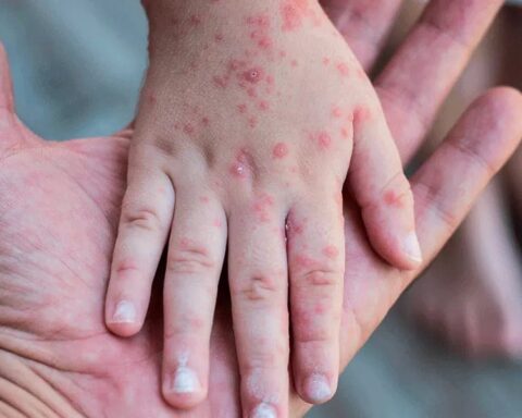 Salud Pública notifica nuevo caso de viruela símica; ya son 32