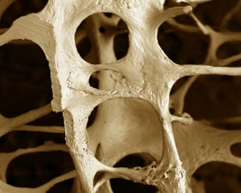 Specialists warn of an increase in patients with osteoporosis in Huancayo