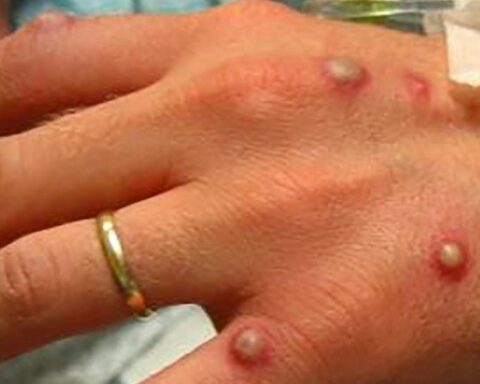 A new case of monkeypox was recorded