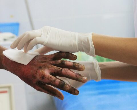 Gunpowder burns increase to 21 in the first three days of December