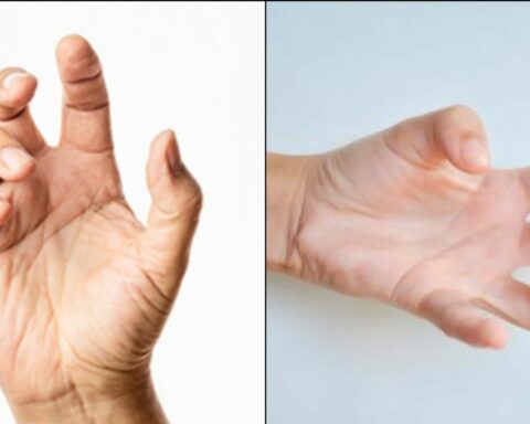 Dystonia patients request coverage to treat involuntary muscle contractions