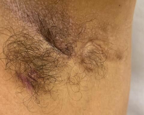 Find out what hidradenitis suppurativa is and what are the risk factors