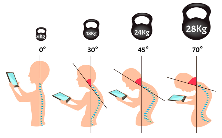 What is the “Text Neck” Syndrome and what are the health consequences?