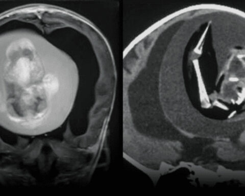 Extirpan un feto con columna vertebral y dedos del cerebro de bebé de 1 año