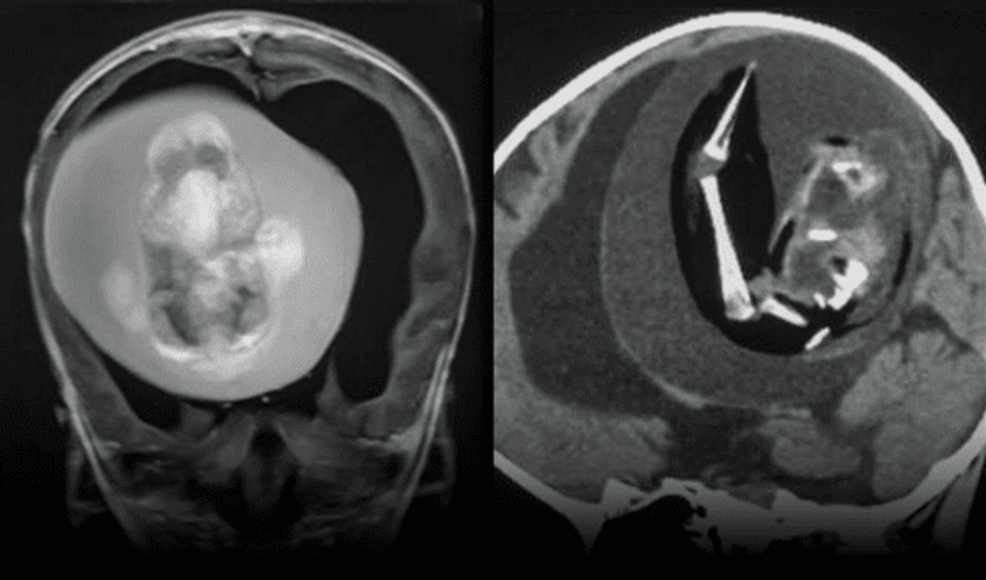 Extirpan un feto con columna vertebral y dedos del cerebro de bebé de 1 año