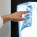 WHO warns of an increase in tuberculosis cases in Europe