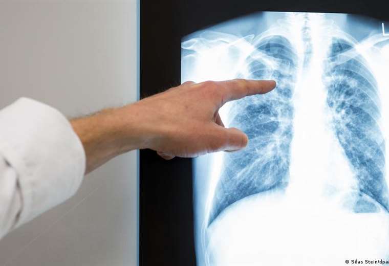 WHO warns of an increase in tuberculosis cases in Europe