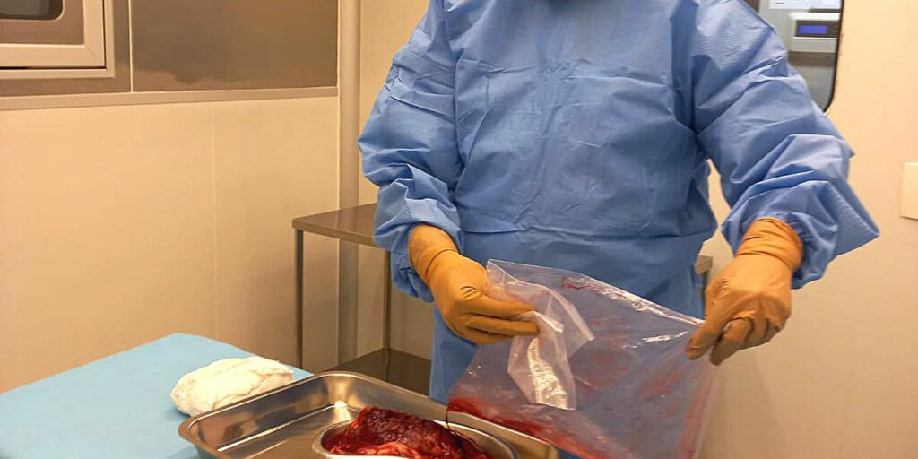 Research develops placenta-based biological dressings