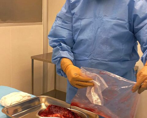 Research develops placenta-based biological dressings