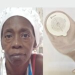 Cubana sin bolsa de colostomía: “no puedo salir de casa”