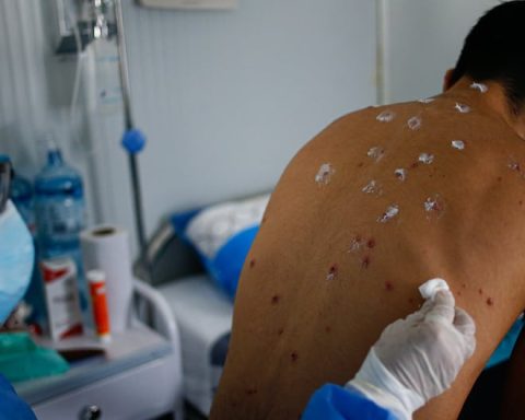 Huancayo: Specialist recommends extreme hygiene and distance to avoid monkeypox