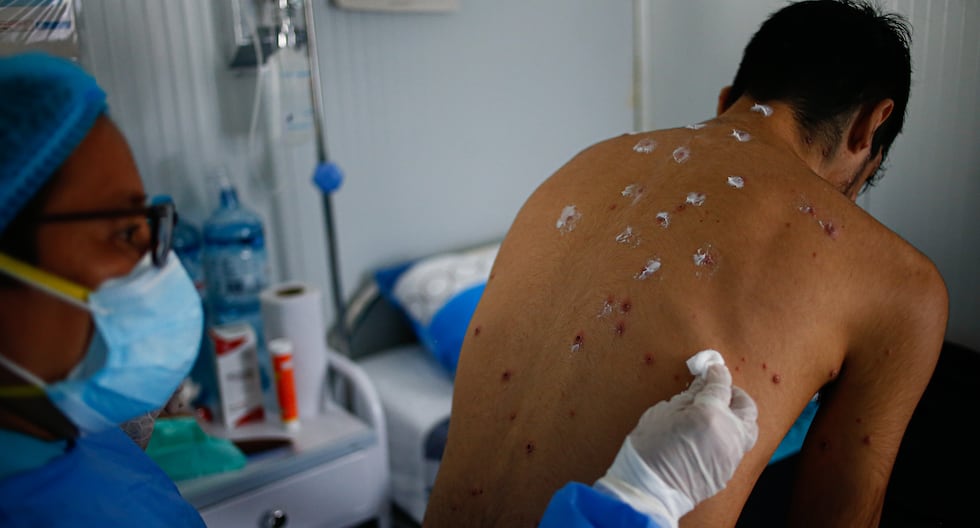 Huancayo: Specialist recommends extreme hygiene and distance to avoid monkeypox