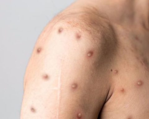 Minsa reports that there are still no cases of a new variant of monkeypox in Peru