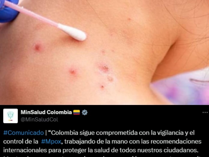 "Vaccines are not ruled out": Ministry of Health in response to 109 cases of monkeypox in Colombia