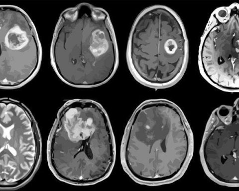 Médicos ven ahora más tumores cerebrales