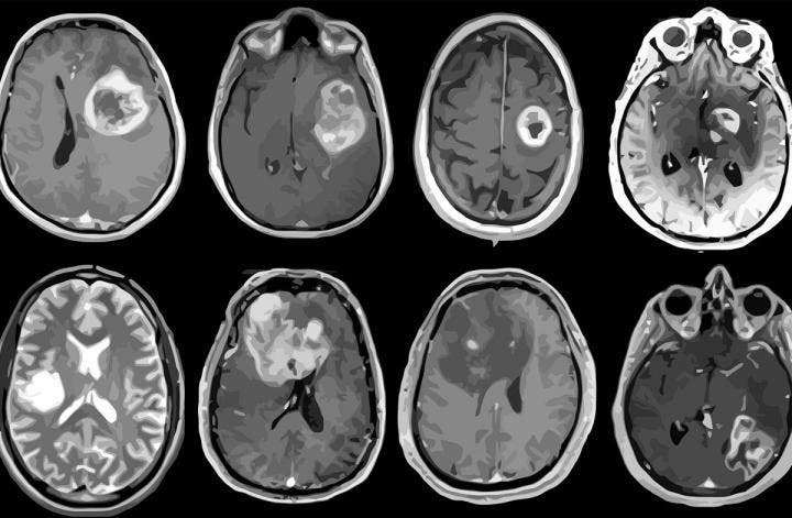 Médicos ven ahora más tumores cerebrales