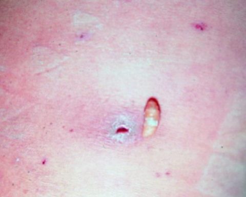 Nicaragua records two cases of people infected with the screwworm