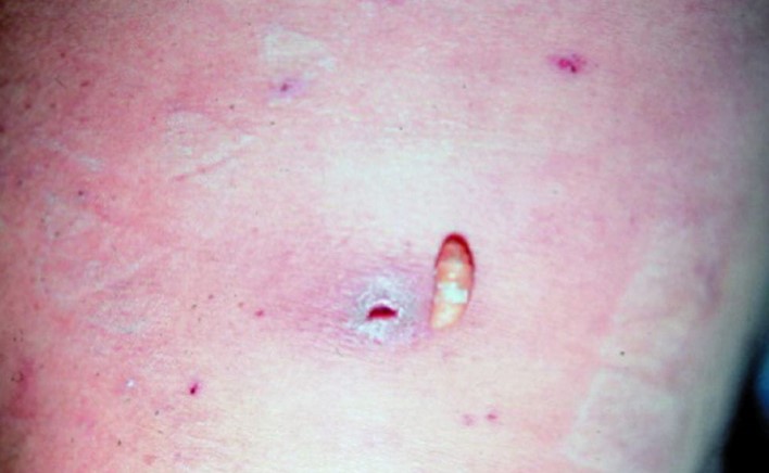 Nicaragua records two cases of people infected with the screwworm