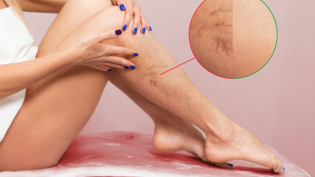 Say goodbye to annoying varicose veins with these 3 kitchen ingredients