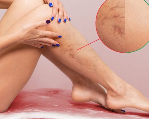 Say goodbye to annoying varicose veins with these 3 kitchen ingredients