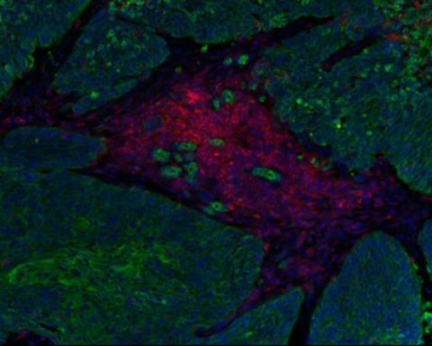 Carcinoma pulmonar no microcítico, donde se muestran las células tumorales (verde) con una infiltración de linfocitos T (en rojo). Imagen cedida por el Centro Nacional de Investigaciones Oncológicas (CNIO).