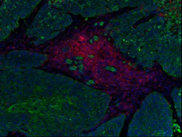 Carcinoma pulmonar no microcítico, donde se muestran las células tumorales (verde) con una infiltración de linfocitos T (en rojo). Imagen cedida por el Centro Nacional de Investigaciones Oncológicas (CNIO).