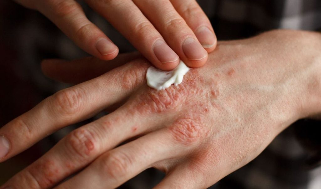 La psoriasis: Un desafío que trasciende la piel