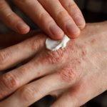 La psoriasis: Un desafío que trasciende la piel