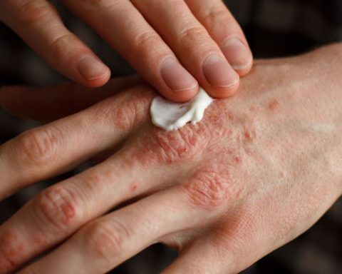 La psoriasis: Un desafío que trasciende la piel