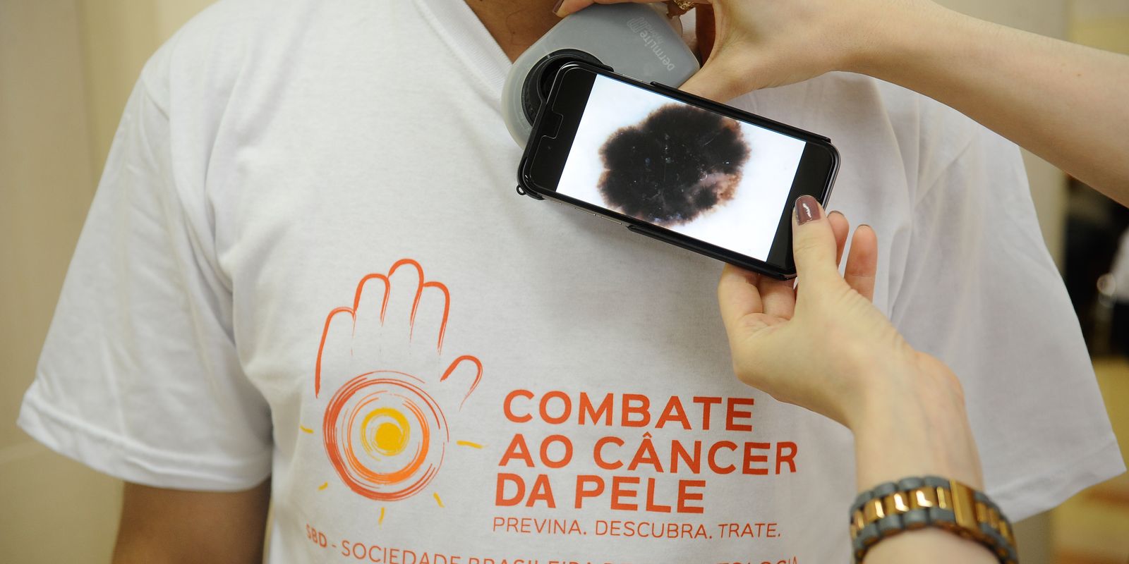 Mutirão serves the population today, on the day to combat skin cancer