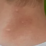 Una persona con picaduras de jejenes en el cuello