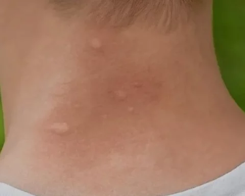 Una persona con picaduras de jejenes en el cuello