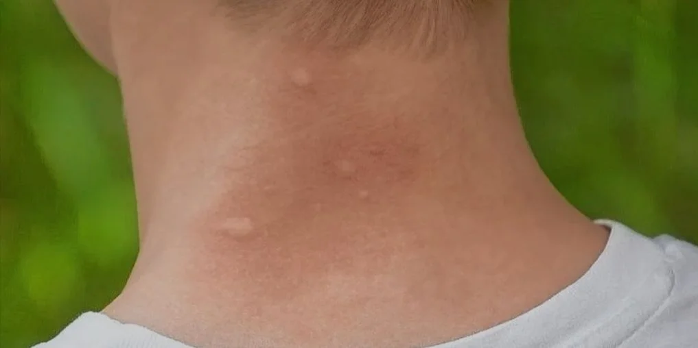 Una persona con picaduras de jejenes en el cuello