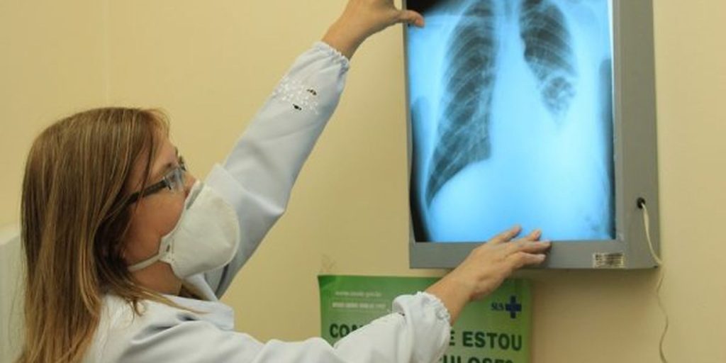 Brazil is against the WHO goal for the extinction of tuberculosis