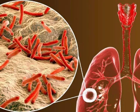 Confirm 34 cases of tuberculosis so far this year in Pando