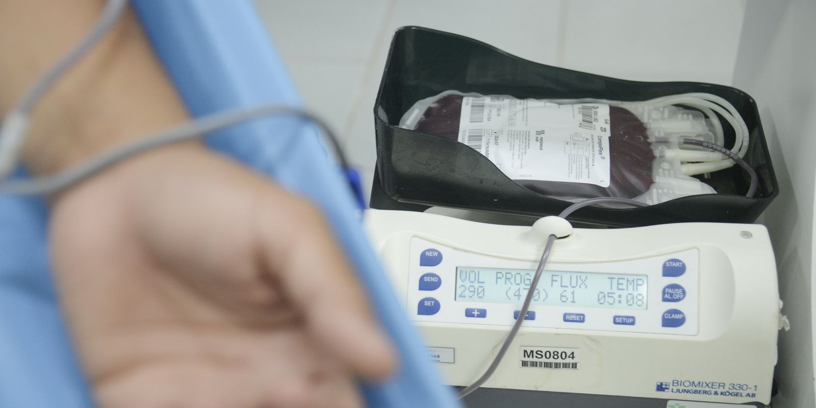 Children with hemophilia will have less invasive therapy through the SUS