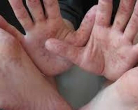 Huancayo: Coxsackie outbreak confirmed in IE and isolation ordered