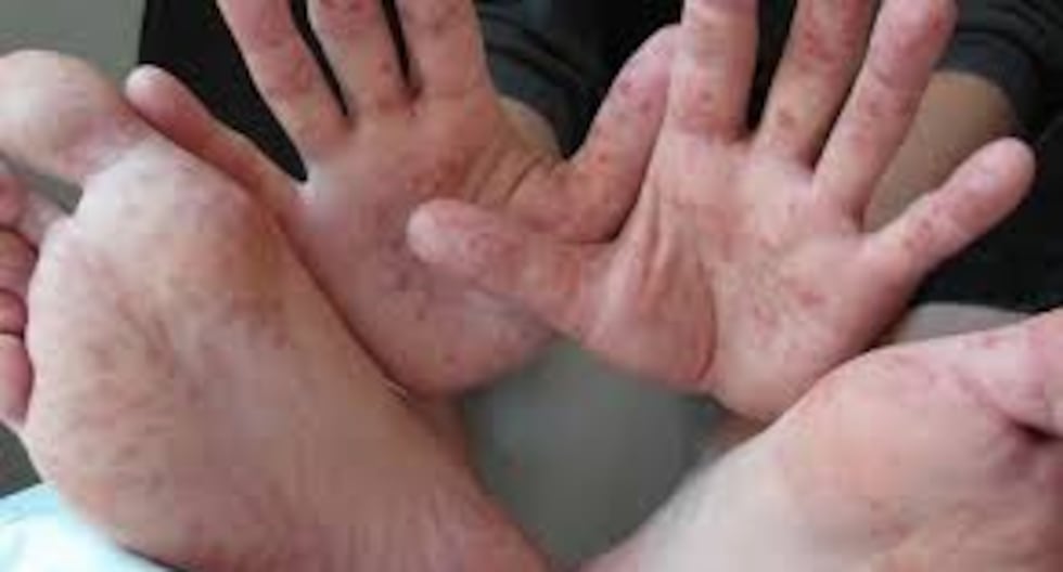 Huancayo: Coxsackie outbreak confirmed in IE and isolation ordered