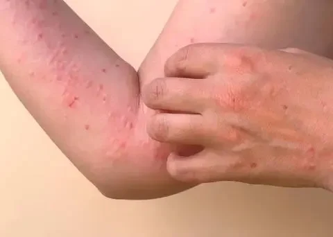 Tres viajeros desde Cuba dan positivo a chikungunya; Salud Pública refuerza vigilancia