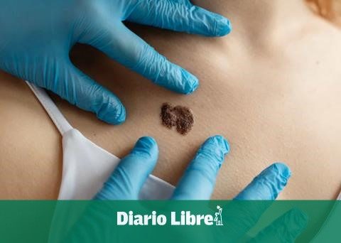 They warn about the silent advance of skin cancer in the country