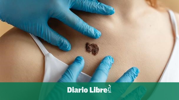 They warn about the silent advance of skin cancer in the country